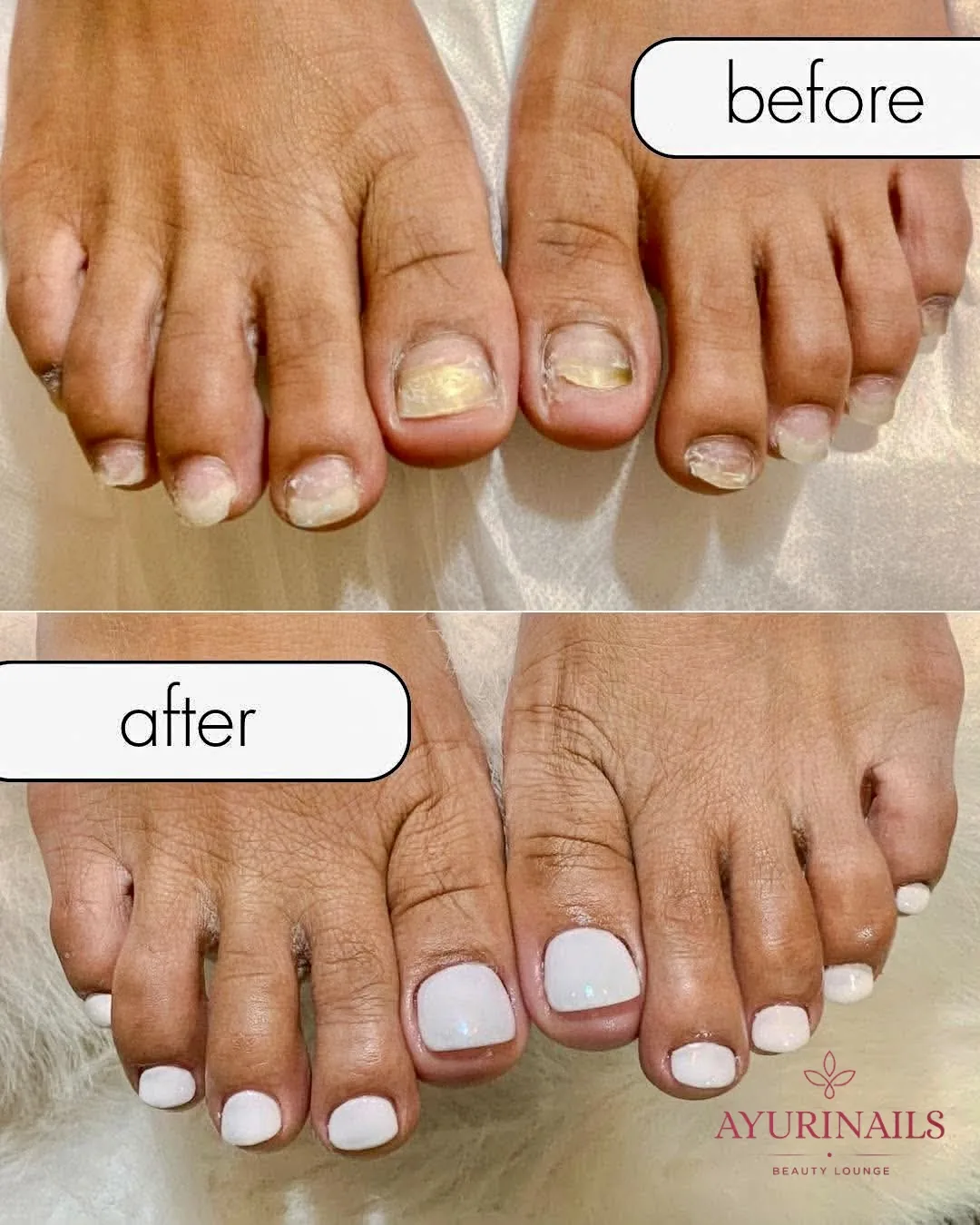 before and after nail reconstruction, damaged toenails rebuilt with white gel, AyuriNails Beauty Lounge Makati